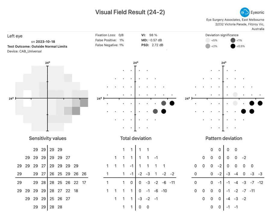 Sample Eyeonic Visual Field Result (24-2) - Outside Normal Limits